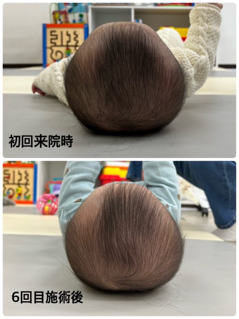 赤ちゃんの頭の形、ヘルメット治療、斜頭、短頭、長頭、向き癖に赤ちゃん整体が効果的 神奈川県大和市中央林間 いえうじ総合治療院