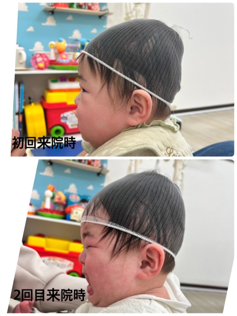 赤ちゃんの頭の形、ヘルメット治療、斜頭、短頭、長頭、向き癖に赤ちゃん整体が効果的 神奈川県大和市中央林間 いえうじ総合治療院
